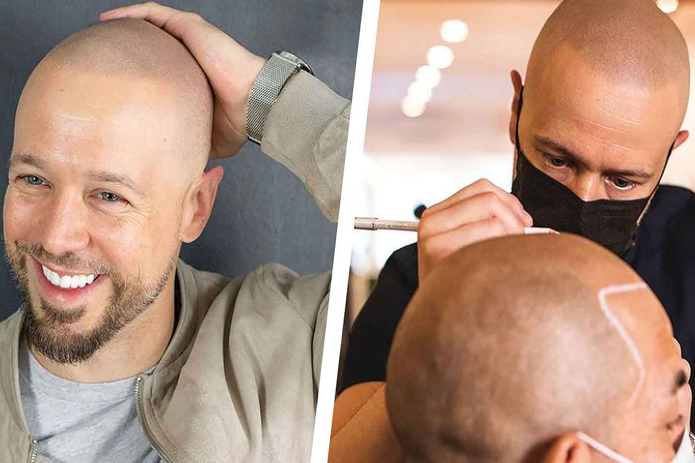 Hair Tattoo A New Technique to Camouflage Thinning Hair StyleSpeak